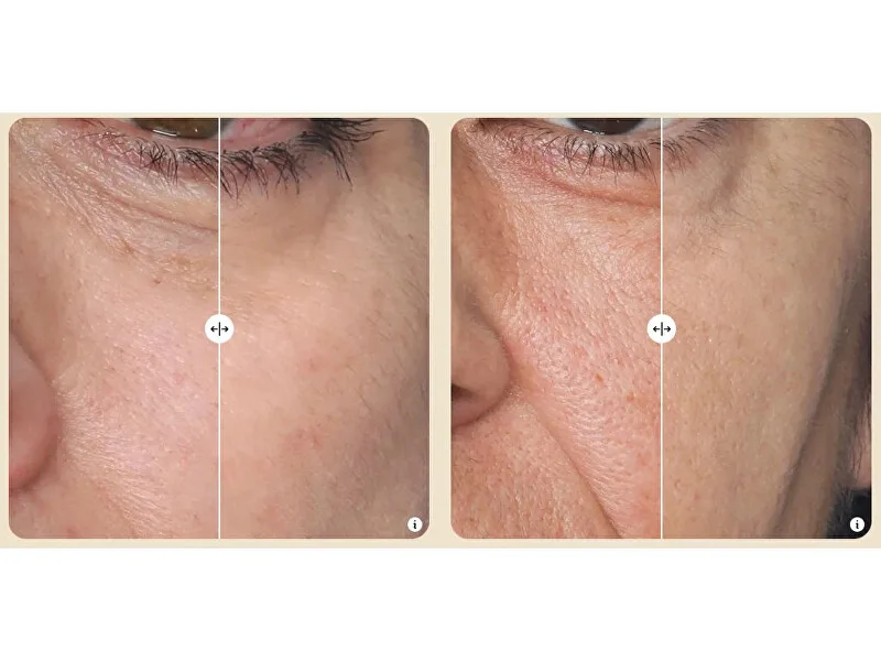 Silk´n FaceTite MultiPlatform skin rejuvenation device thumbnail 2