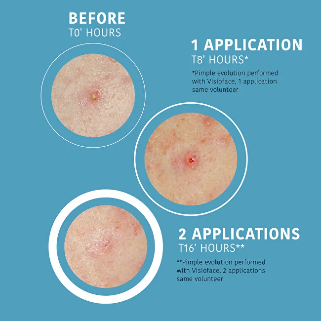 Iroha Patches for acne and skin imperfections SOS Pimple Patches 18 pcs thumbnail 3