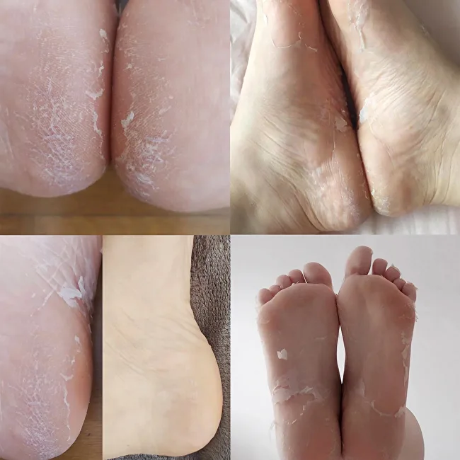 Iroha Peeling and exfoliation foot mask Peeling Foot Mask 1 pair thumbnail 3